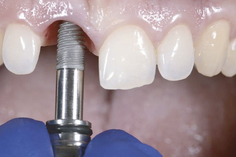 implantes dentales