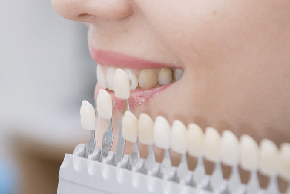 SERVICIO CARILLAS DENTALES